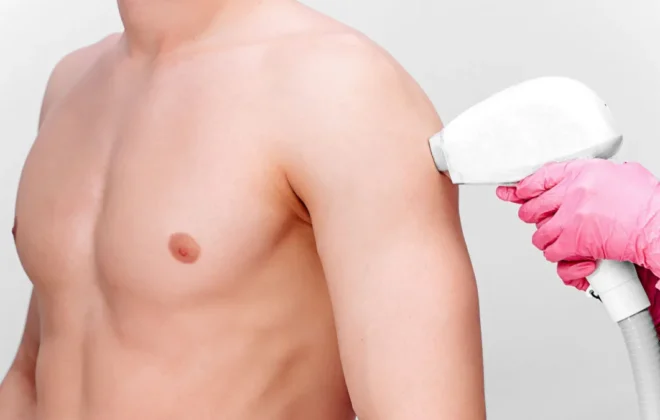 depilazione uomo laser