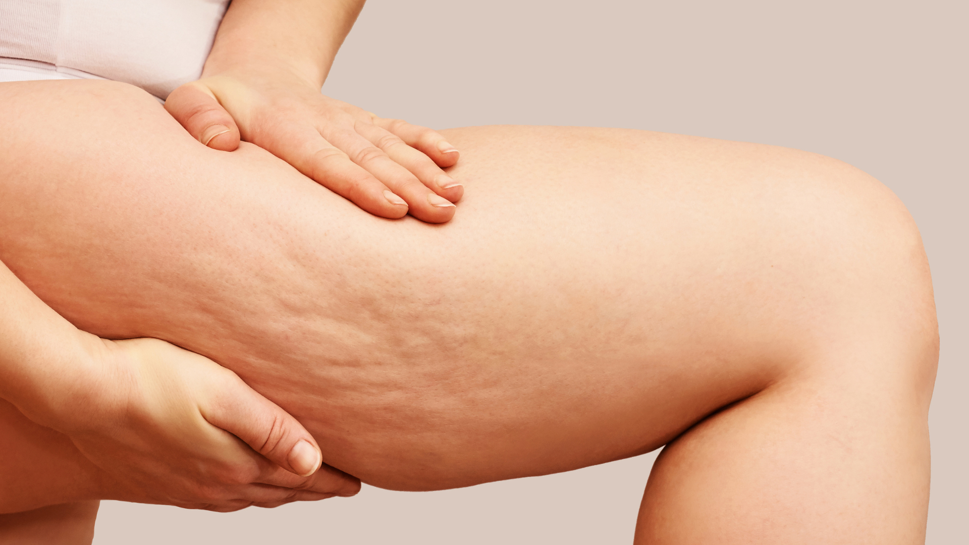 Tipi di Cellulite: Come Riconoscerli